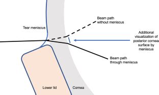 Clinical application of the tear film prism 